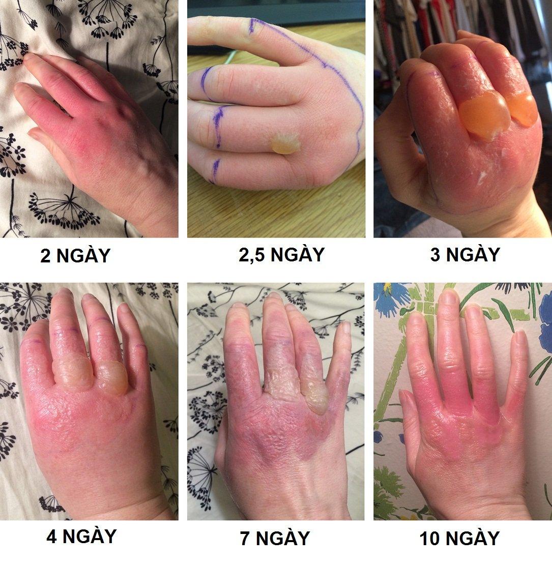 Viêm da tiếp xúc ánh sáng thực vật bị nhầm lẫn với các tình trạng viêm da tiếp xúc