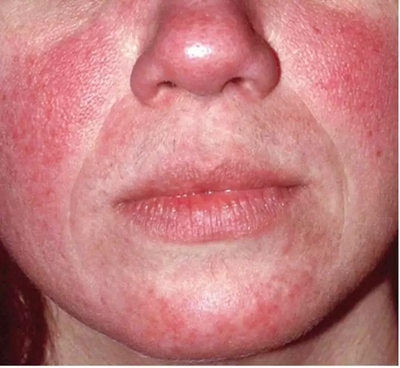 BỆNH DA DO KÍ SINH TRÙNG DEMODEX (DEMODICOSIS)