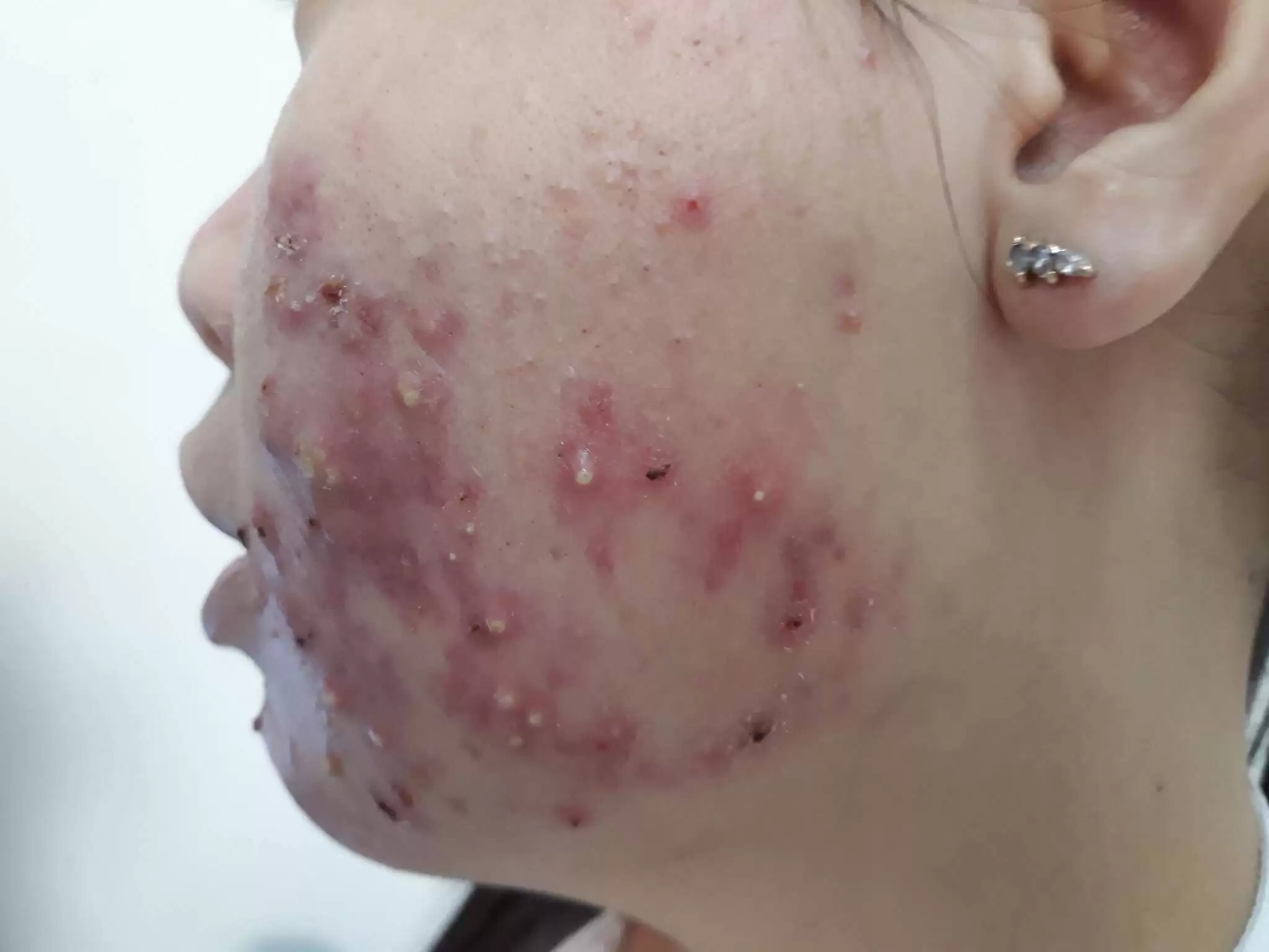 BỆNH DA DO KÍ SINH TRÙNG DEMODEX (DEMODICOSIS)