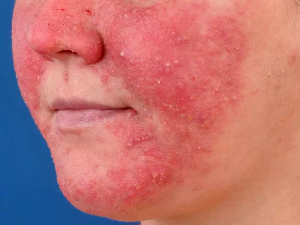 BỆNH DA DO KÍ SINH TRÙNG DEMODEX (DEMODICOSIS)