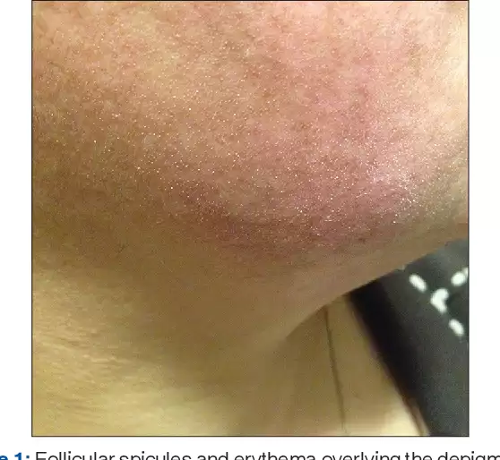 BỆNH DA DO KÍ SINH TRÙNG DEMODEX (DEMODICOSIS)
