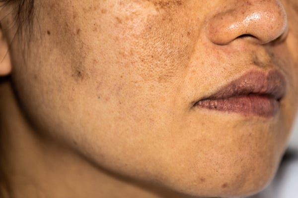 nám mảng ở mặt phụ nữ